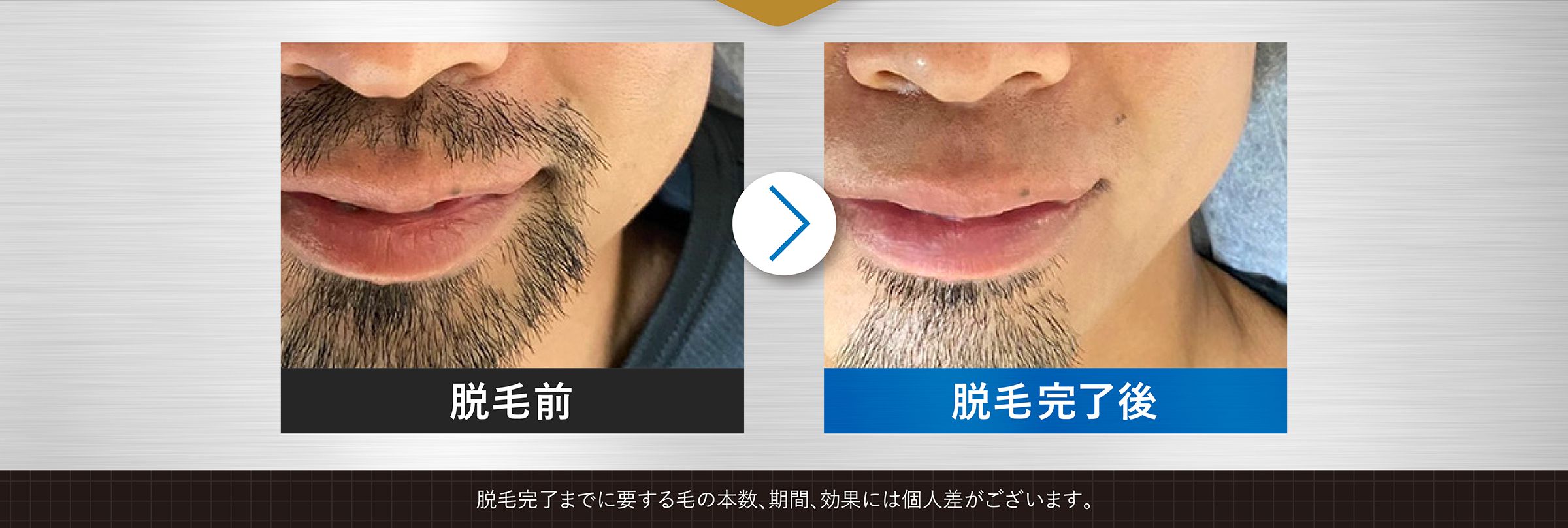 脱毛完了までに要する毛の本数、期間、効果には個人差がございます。