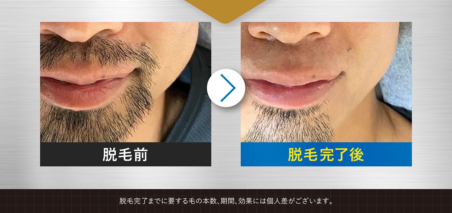 脱毛完了までに要する毛の本数、期間、効果には個人差がございます。