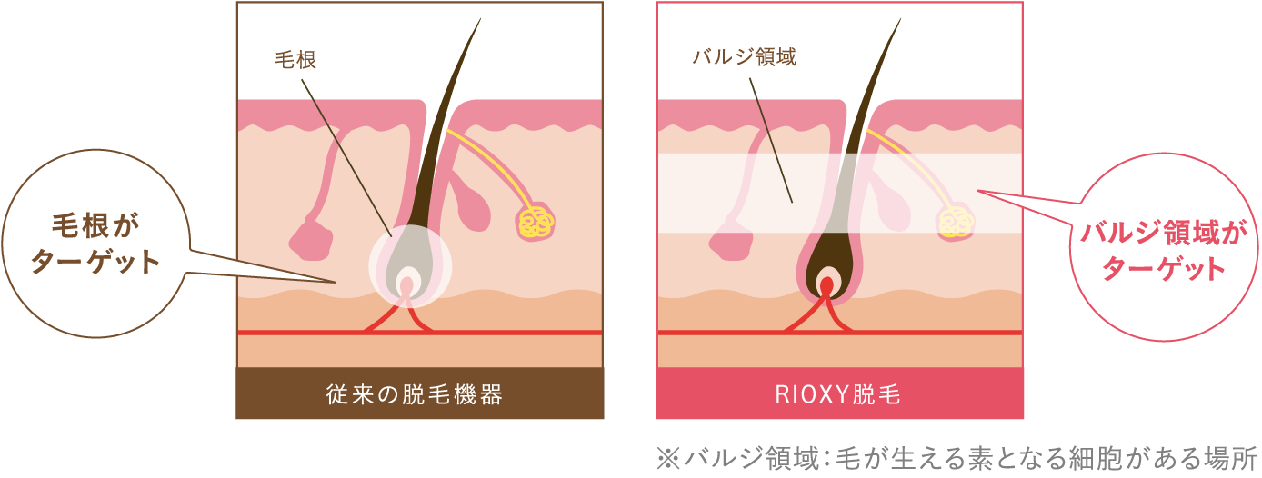 毛根がターゲットバルジ領域がターゲット