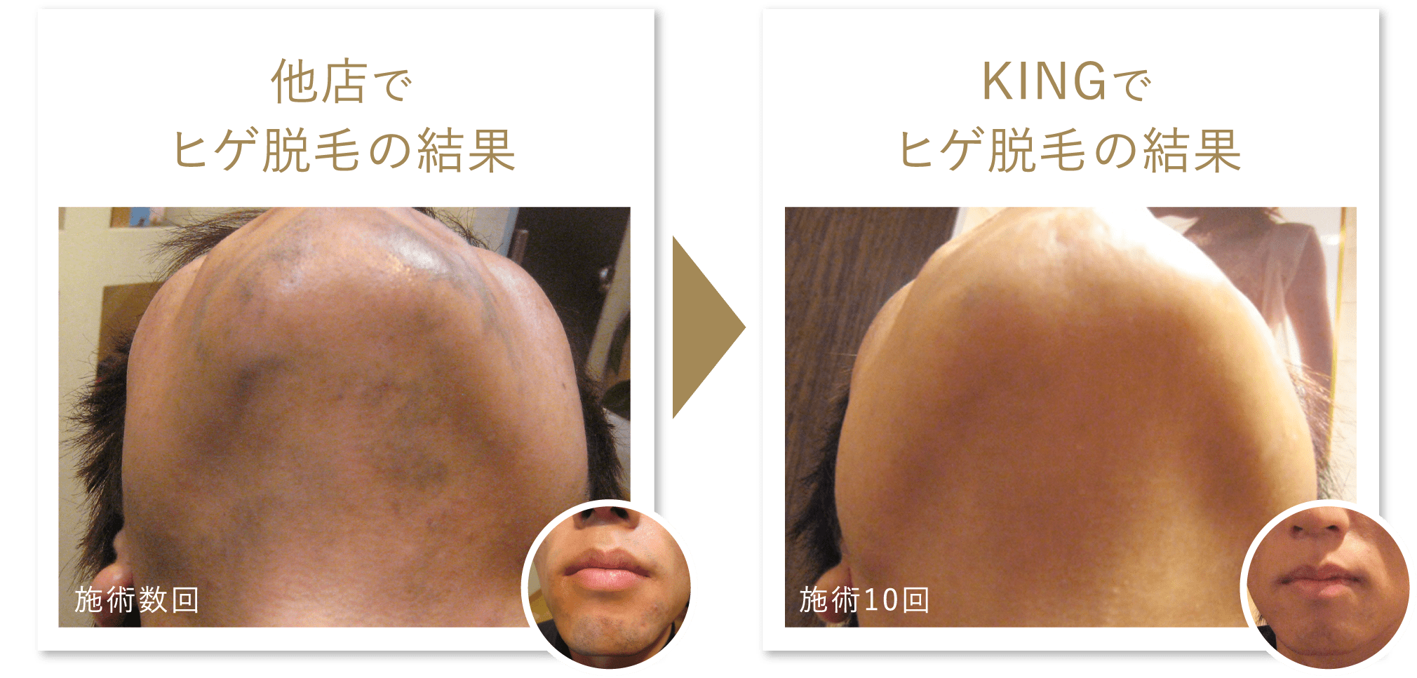 他店でヒゲ脱毛の結果KINGでヒゲ脱毛の結果